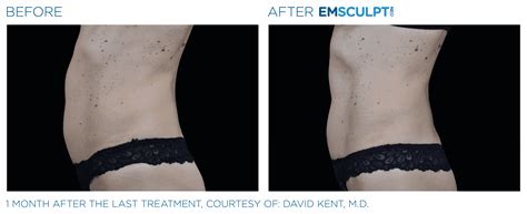 Emsculpt Neo Near Me Build Muscle And Burn Fat Permanently Naperville