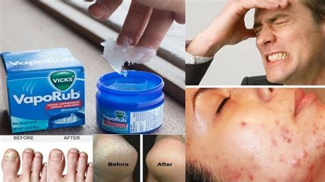 Surprising Uses for Vicks VapoRub | 8 Amazing Uses & Benefits of Vicks ...