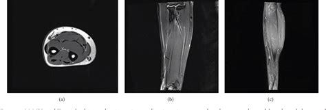 Figure From Intravascular Glomus Tumor Of The Forearm Causing Chronic