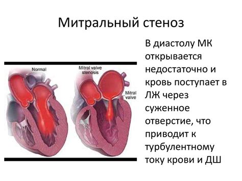 Аускультация сердца - online presentation