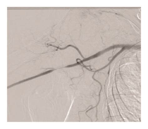 Tapered High Grade Stenosis Of The Proximal Right Brachial Artery With