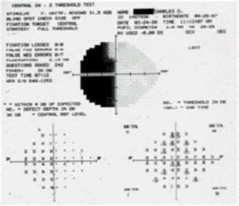 Pituitary Tumor: Visual Field Defect With Pituitary Tumor