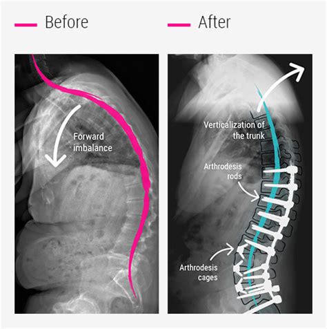 Scoliosis Surgery Ccv Montpellier