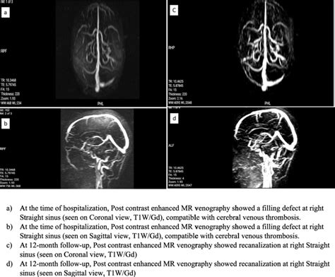 Contrats Enhanced Magnetic Resonance Venography Of A Patient With