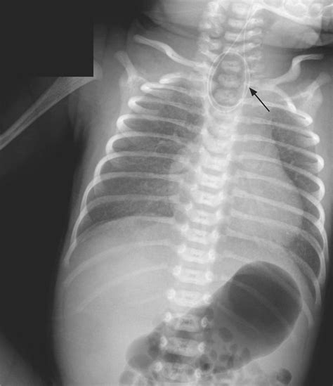 Esophageal Atresia And Tracheoesophageal Fistula Medizzy