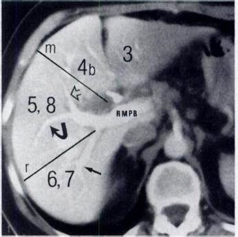 -Axial spiral CT scan obtained during arterial portography in plane of... | Download Scientific ...