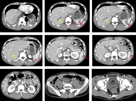 Blunt Liver And Spleen Injuries Ct Grading Versus Intra Operative