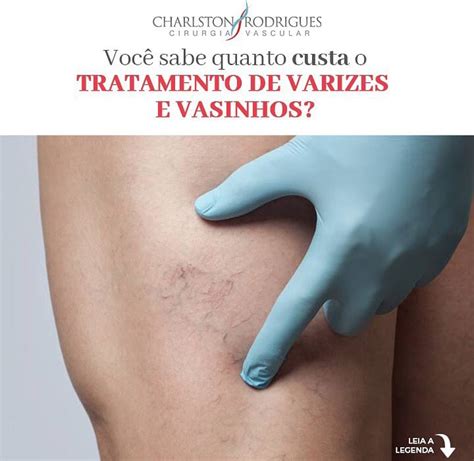 Quanto Custa O Tratamento De Varizes E Vasinhos Dr Charlston Rodrigues