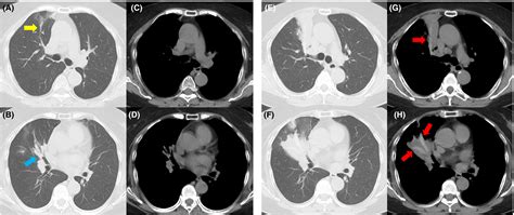 Mucus Plugs In Peripheral Bronchi An Unusual Initial Manifestation Of