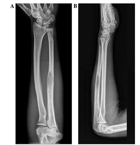 Ewing S Sarcoma Of The Ulna Treated With Sub Total Resection And