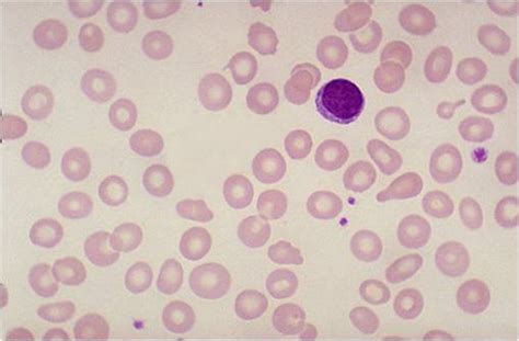 Iron deficiency anemia pathophysiology - wikidoc