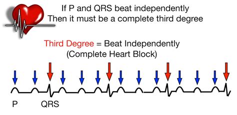 Incontable Roble Deportista Second Or Third Degree Heart Block Para So