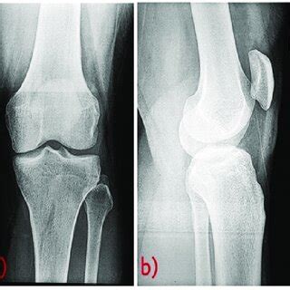 Radiograph Of The Left Knee In Anteroposterior And Lateral View At