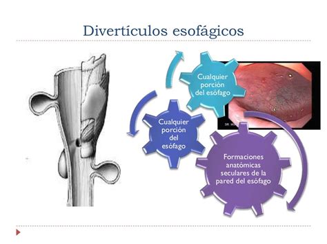 Diverticulos Esofagicos Hospital General Balbuena