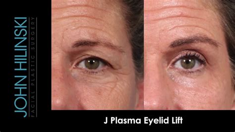 Non Surgical Eyelid Lift Youtube