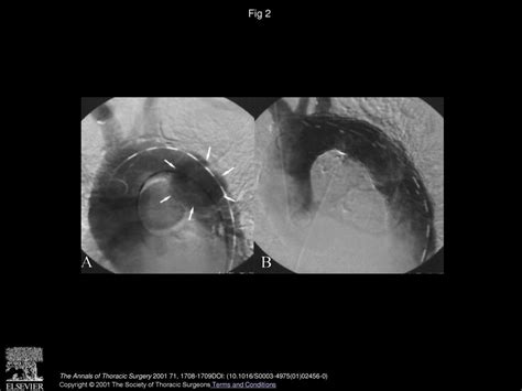 Aortic Stent Graft For Patent Ductus Arteriosus In Adults The Aortic Exclusion Technique