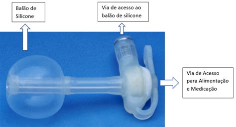 Gastrostomia Saiba O Que é Gastrostomia Quando é Indicada Os Tipos