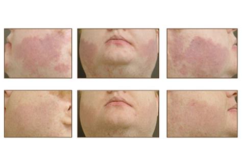 Blood vessel treatment: Rosacea, Facial Redness, Telangiectasias ...