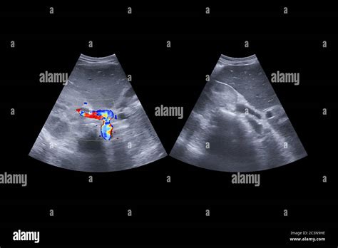 Ecograf A Del Abdomen Superior Que Muestra Anatom As Del Sistema