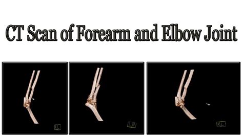 CT Scan Of Forearm And Elbow Joint Technique YouTube