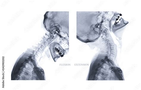 X-ray image of Cervical spine Lateral Flexion and extension view show iintervertebral disc ...