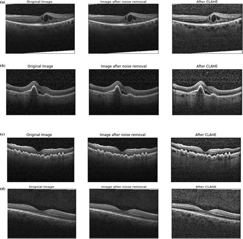 image processing step outcomes    classes  diseases  dme