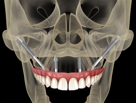 Zygomatic Implants Leeds Hq Dental