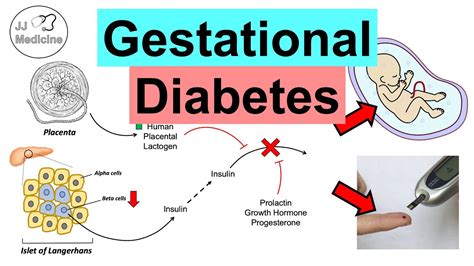 Causes Of Diabetes Diabetes