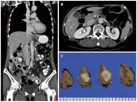 Successful Resection Of Metachronous Para Aortic Virchow Lymph Node