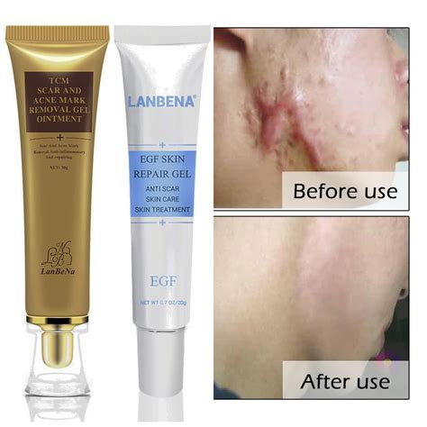 Aliexpress.com : Buy Scar Cream Acne Scar Removal Cream Skin Repair ...