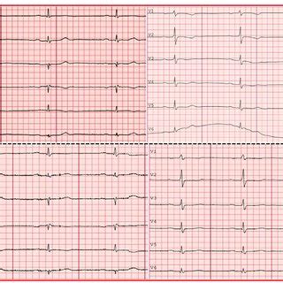 Electrocardiogram On Admission Upper Panel Showing Sinus Rhythm And