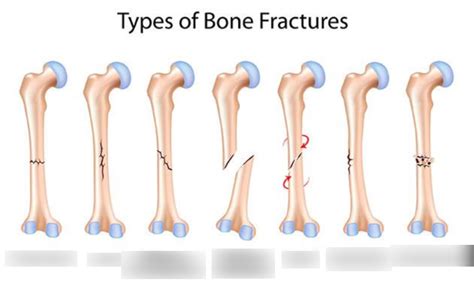 Types Of Bone Fractures Diagram Quizlet