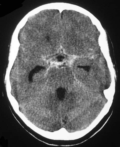 Acute subarachnoid haemorrhage - Radiology at St. Vincent's University Hospital