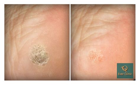 Wart Verruca Removal Glasgow Laser Treatment Clinic Scotland