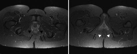 Fistula In Ano Mri