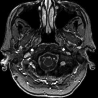 T1 Weighted Post Contrast Axial Magnetic Resonance Image Showing