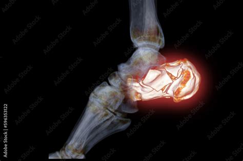 Calcaneus Heel Bone Fractures Exercises Hot Sex Picture