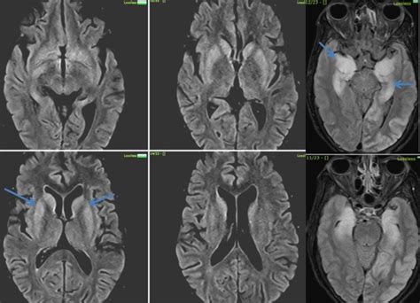 Ebv Encephalitis Axial Flair Images Show Cortical Swelling With Download Scientific Diagram