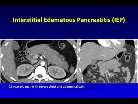 Necrotic Pancreatitis Ct Scan