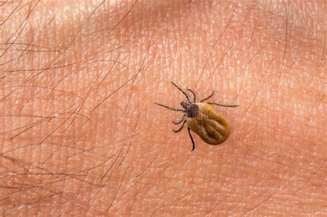 Tick On Human Body