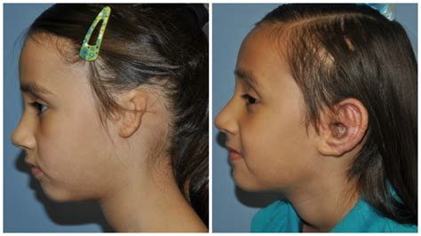 Unilateral Microtia After Medpor Outer Ear Reconstruction The Microtia And Atresia Clinic At