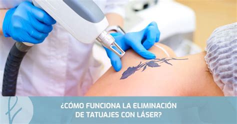 C Mo Funciona La Eliminaci N De Tatuajes Con L Ser Medicina Est Tica