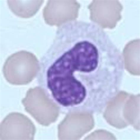 Anemia - QSP Blood Cell Morphology Newsletter #40 (HORIBA Medical) 