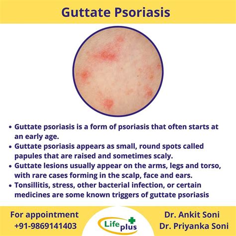 Guttate Psoriasis