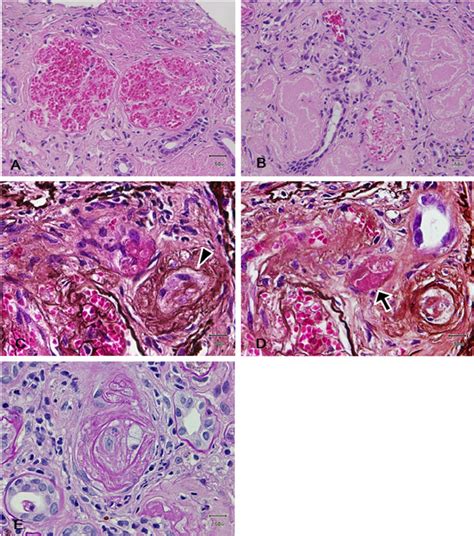 Histopathological Findings Of Renal Biopsy A Light Photomicrograph