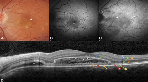 Bacillary Layer Detachment In Acute Posterior Multifocal Pla Retina