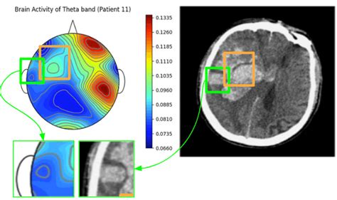 Comparison Of Visualization Of Theta Wave Activity In Patient From