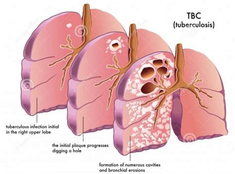 Tuberculosis - Condition and Treatment - AirPhysio