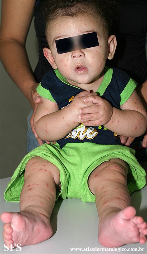 Acrodermatitis Infantile Papular Nc Commons