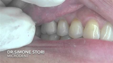 Dente Affetto Da Parodontite Severa Curato Con Laser YouTube